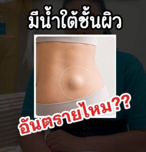Seroma คืออะไร? อาการ สาเหตุ และวิธีป้องกันหลังดูดไขมัน