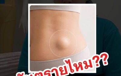 Seroma คืออะไร? อาการ สาเหตุ และวิธีป้องกันหลังดูดไขมัน