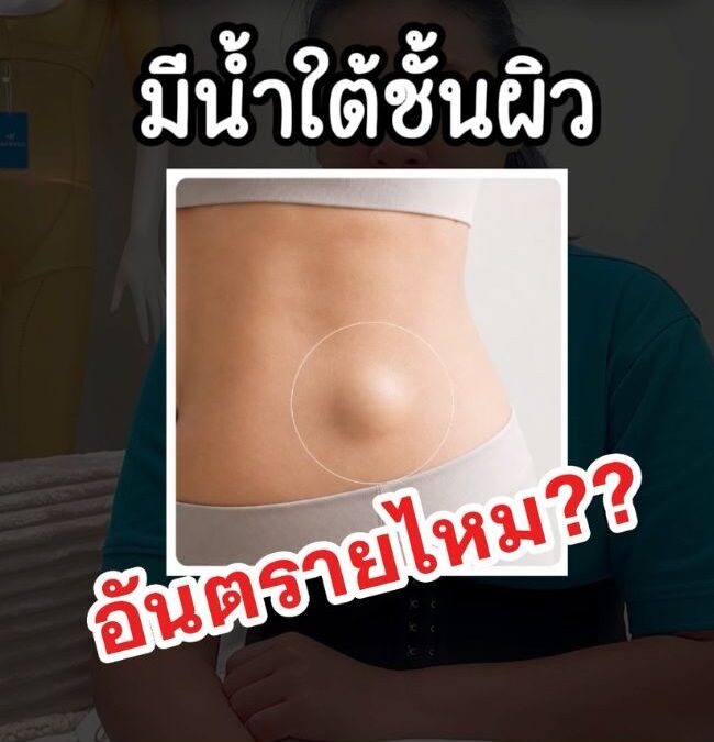 Seroma คืออะไร? อาการ สาเหตุ และวิธีป้องกันหลังดูดไขมัน